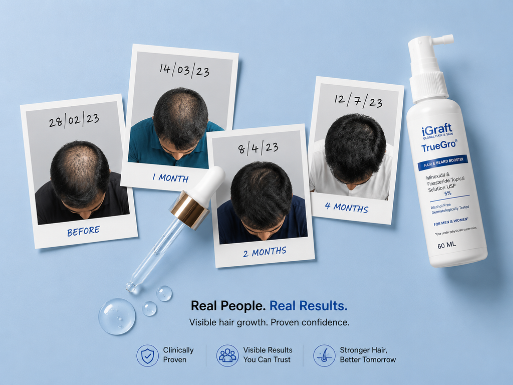 iGraft TrueGro Minoxidil 5% + Finasteride 0.1% | Hair Growth Solution 60ml